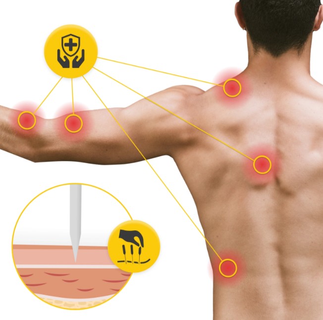 Igły do akupunktury z prowadnicą 100 szt- 4Fizjo 2,1.jpg