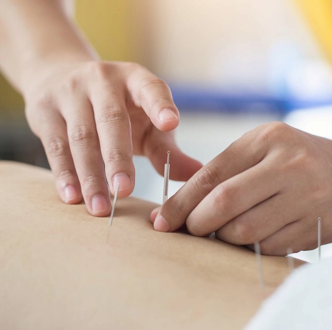 Igły do akupunktury z prowadnicą 100 szt- 4Fizjo 20.jpg